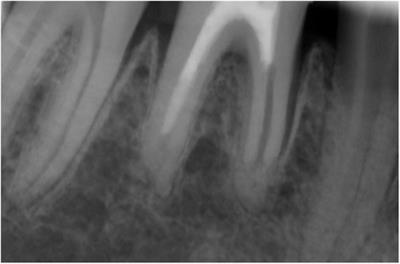 <mark class="highlighted">Dental health</mark> of patients with X-linked hypophosphatemia: A controlled study